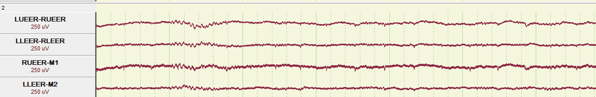 In-ear EEG channels from an overnight record