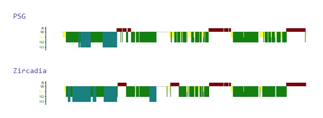 Two scored hypnograms from one overnight record, in-ear compared with PSG